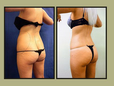 bra fat Liposuction back