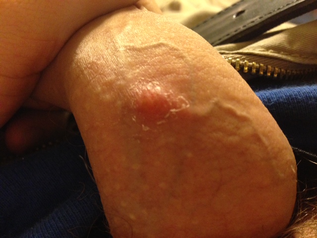 scabs dick that become Bumps on
