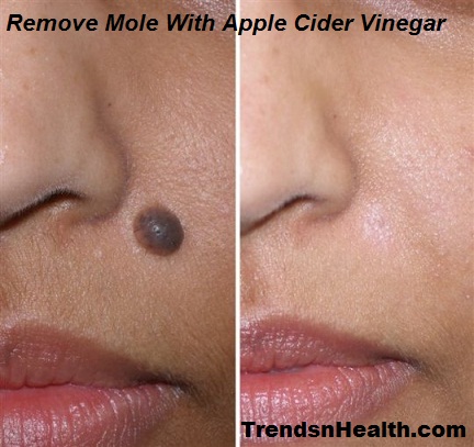 facial moles Removing